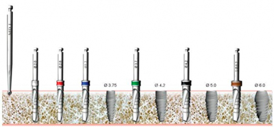 Схема использования цилиндрических сверл для имплантатов «Респект»