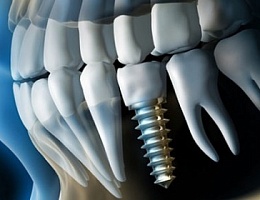 В чём состоит проблема оголения зубного имплантата?
