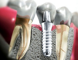 Зубной имплантат нового поколения